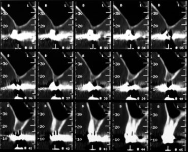 Scarsa disponibilità ossea nel settore posteriore (< 4 mm) che impone il grande sollevamento del pavimento del seno  mascellare
