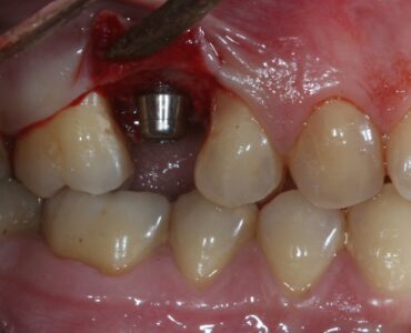Impianto inserito in centro cresta in posizione equicrestale o 0.5mm sotto. Lo spessore crestale vestibolare dopo l'osteotomia deve avere 1.2-2mm di spessore per evitare/limitare il riassorbimento crestale