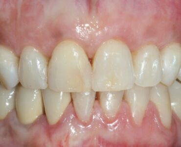 Guarigione a 12 mesi dopo restauro delle lesioni cervicali